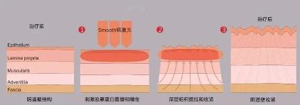 陰道松弛了,尷尬事和鬧心事就會(huì)接踵而至